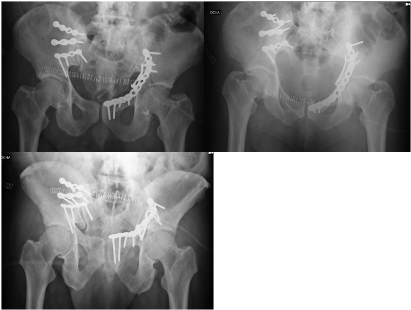 Figura 3. Figura 3. Control postquirúrgico, mediante radiografías con proyección anteroposterior, inlet y outlet. Osteosíntesis de fractura acetabular izquierda mediante dos placas suprapectíneas y fijación de articulación sacroilíaca derecha mediante tres placas anteriores ilíacosacras.