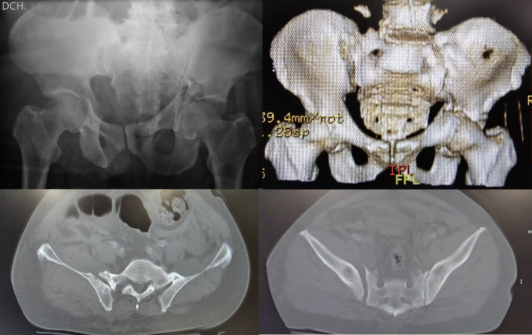 Figura 1. Figura 1. Radiografía anteroposterior (A), reconstrucción 3D (B) y corte axial del TC (C, D), donde se observa una fractura transversa de acetábulo izquierdo con apertura de la articulación sacroilíaca derecha. Se observan signos de dismorfia de sacro tipo IV: apófisis transversa prominente bilateral, con fusión completa al sacro en el lado izquierdo (dismorfia tipo III) y fusión incompleta en el lado lesionado (dismorfia tipo II).