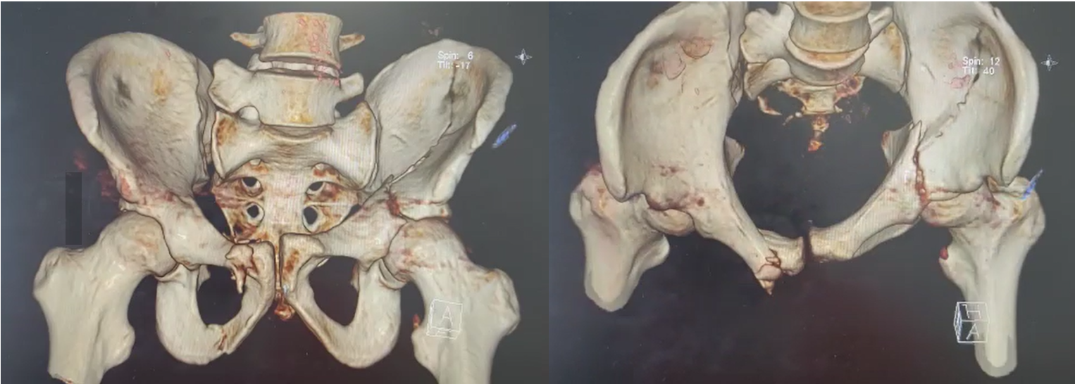 Figura 2. Figura 2. Reconstrucción 3D del TC, observando fractura de ramas iliopúbica e isquiopúbica derechas, con apertura de la articulación sacroilíaca ipsilateral y fractura acetabular de columna anterior y hemitransversa posterior contralateral. Se observan signos de dismorfia de sacro tipo II: apófisis transversa prominente que articula con el sacro sin estar fusionada.
