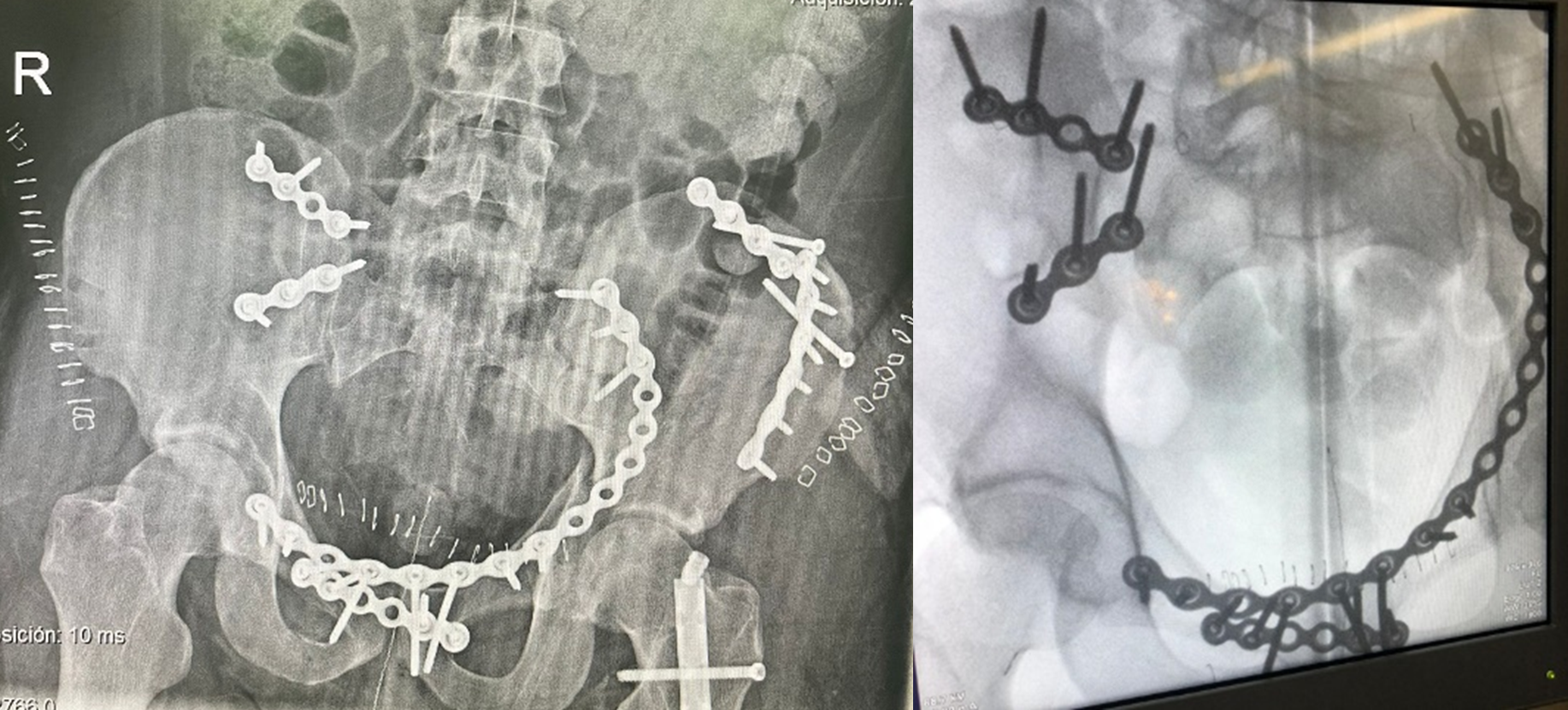 Figura 4. Figura 4. Imagen intraoperatoria y control postquirúrgico tras osteosíntesis de fractura acetabular izquierda y de ramas mediante placa suprapectínea desde la rama iliopúbica derecha hasta el sacro izquierdo, placa anterior en pubis y dos placas en pala ilíaca izquierda y fijación de articulación sacroilíaca derecha mediante tres placas anteriores ilíacosacras.