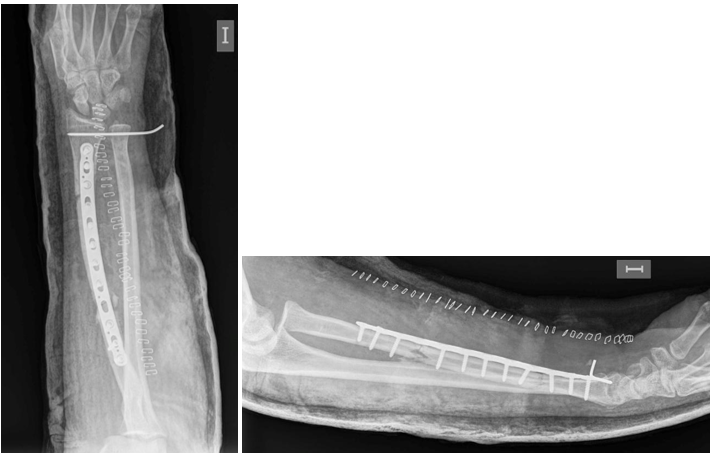 Figura 3. Radiografías AP y lateral a las 3 semanas de la primera cirugía, donde se aprecia luxación de la cabeza radial con correcta alineación de la articulación cubitohumeral