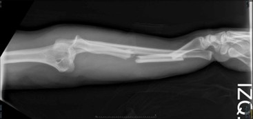 Figura 1. Radiografías en urgencias. Se observa fractura diafisaria bifocal de radio con luxación de codo y de la articulación radiocubital distal