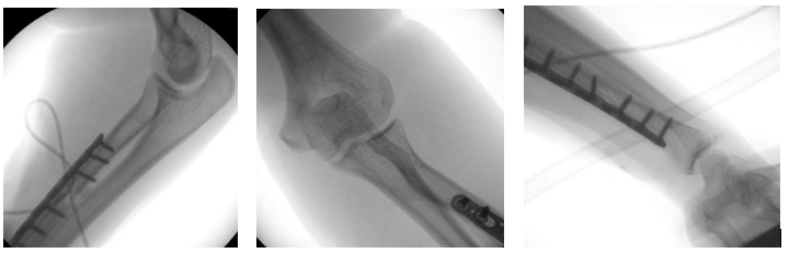 Figura 2. Escopia intraoperatoria tras la primera cirugía. A y B correcta congruencia radiocapitelar y cubitohumeral. C luxación de ARCD