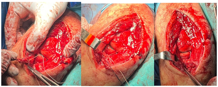 Figura 4. Imágenes intraoperatorias de la plastia de tríceps trasladada de posterior a anterior, manteniendo su inserción en el olécranon y finalmente anclada sobre la cresta supinadora.