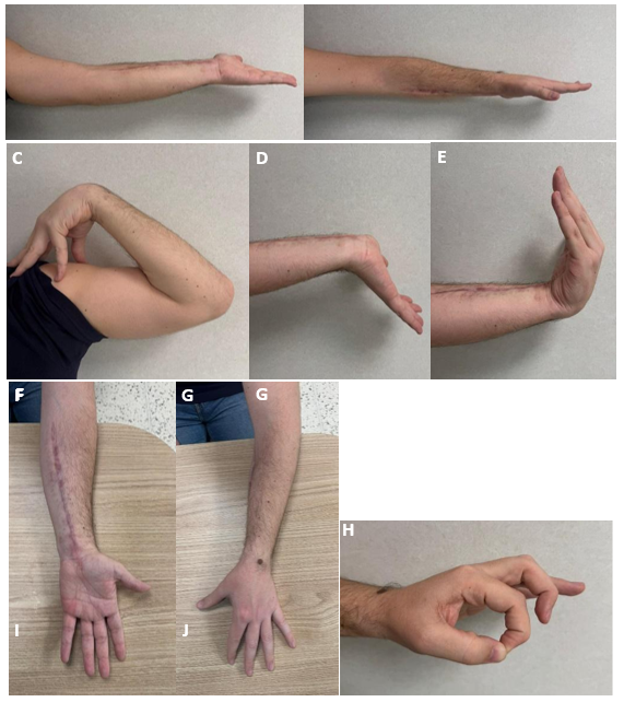Figura 6. Imágenes en consulta de la movilidad a los 6 meses. Presenta movilidad completa de muñeca y flexoextensión de codo completa. Pérdida de pronación de 15-20o. A nivel neurovascular muestra una mejoría clínica del nervio interóseo anterior con fuerza 4 sobre 5 al realizar la pinza. Ambas articulaciones son estables sin dolor (Figura 6).
